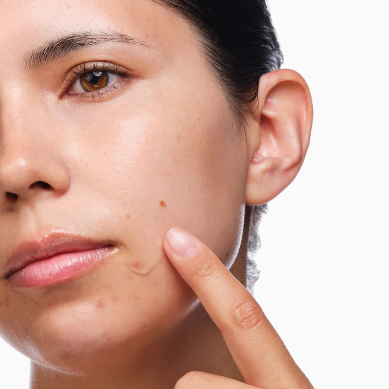 The Acne Set - skin care and cosmetics